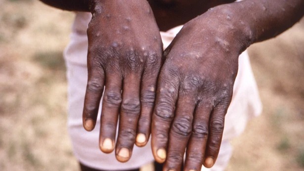 Mombasa records two Mpox deaths as cases rise sharply